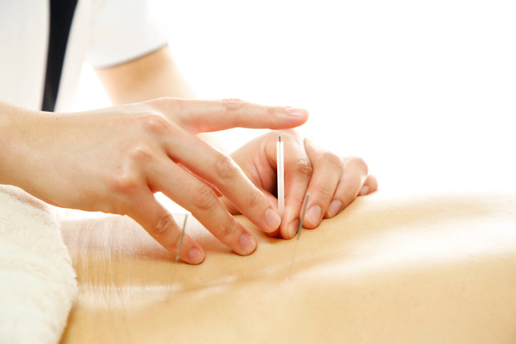 What Is Acupuncture Actually Like?